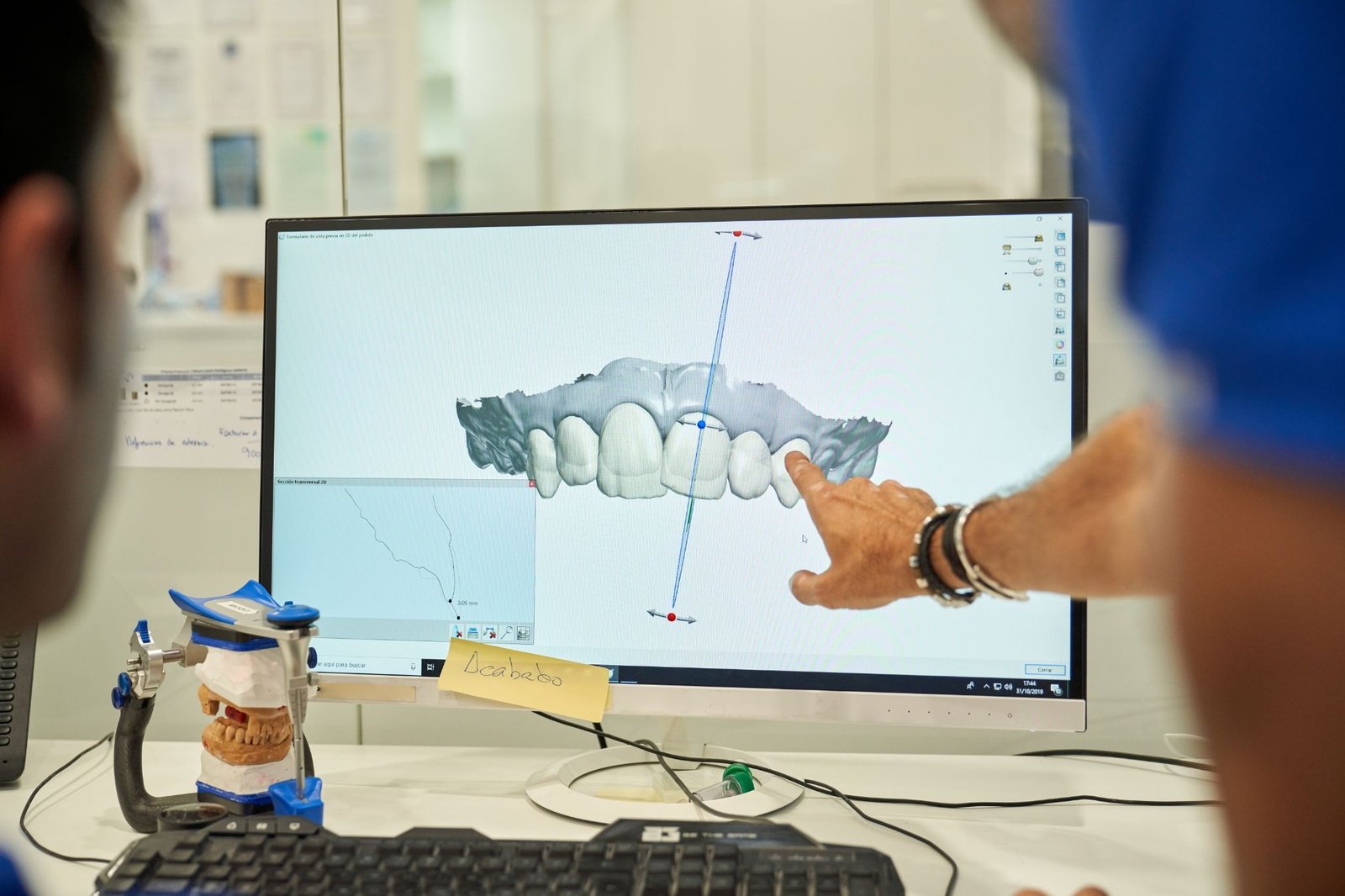 3D digital orthodontic treatment planning displayed on a computer screen during a dental consultation for clear aligner smile design